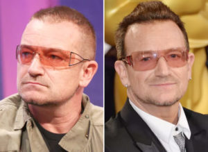 Top 20 Famous Celebrity Hair Transplants Before And After