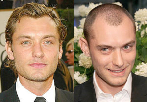 Top 20 Famous Celebrity Hair Transplants Before And After